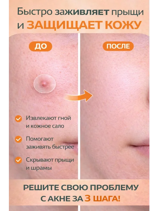 iBeaLee Acne Clear Patch — ультратонкие пластыри от прыщей с…, вариант, фото 5