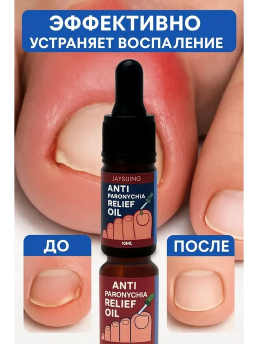TAIS Масло от грибка ногтей средство от вросших ногтей паронохии, вариант