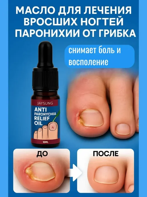 TAIS Масло от грибка ногтей средство от вросших ногтей паронохии, вариант, фото 4
