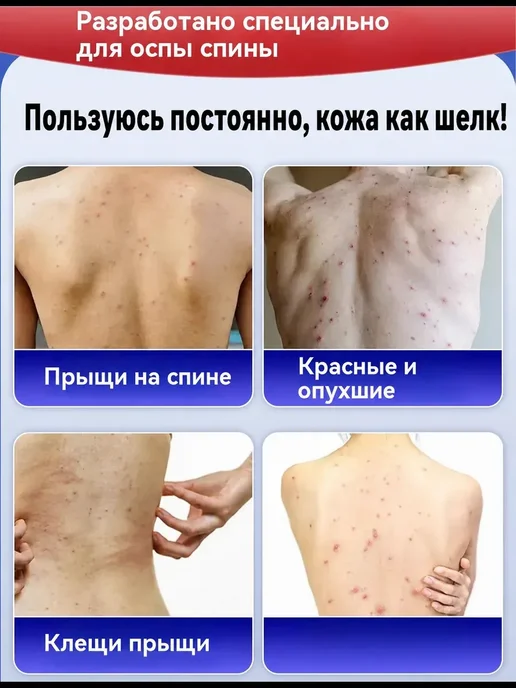 мыло от прыщей на лице для подростков, вариант, фото 2