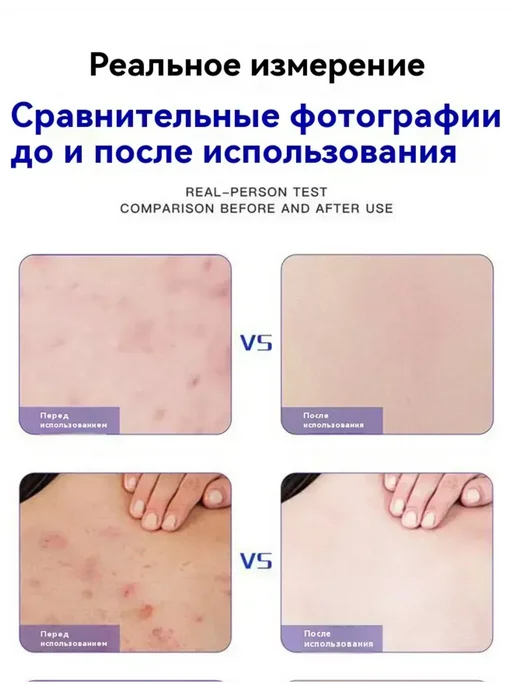 мыло от прыщей на лице для подростков, вариант, фото 3