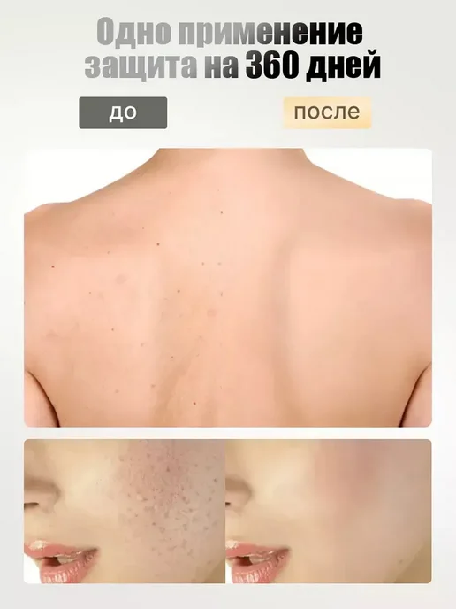 мыло от прыщей на лице для подростков, вариант, фото 4