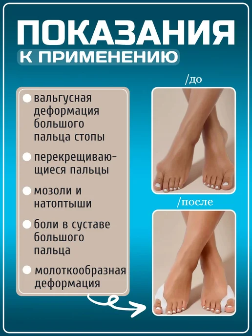 Разделитель для пальцев ног силиконовый бурсопротектор, белый, фото 2