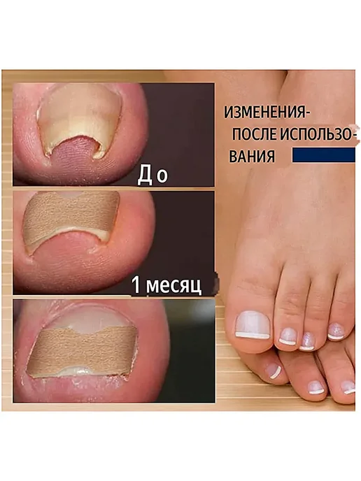 Канида Корректор вросшего ногтя в домашних условиях 50шт, 50 шт