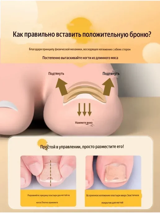 Канида Корректор вросшего ногтя в домашних условиях 50шт, 50 шт, фото 2